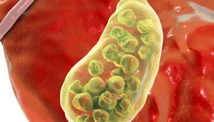 Gallbladder Stone: પેટમાં ગયાની સાથે પથરી બની જાય આ 4 વસ્તુઓ, પછી માત્ર ઓપરેશન જ ઈલાજ, ખાતા પહેલા 1000 વાર વિચારજો