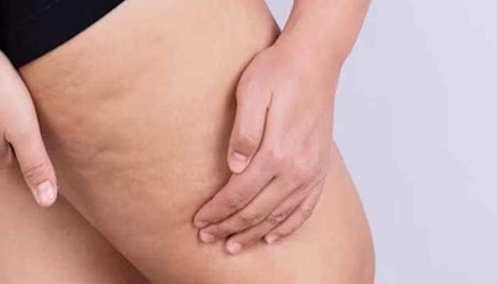 Lower Body Fat: કમર, સાથળ, જાંઘ પર જામેલી ચરબી ઉતારવાનો સૌથી અસરકારક દેશી ઉપાય