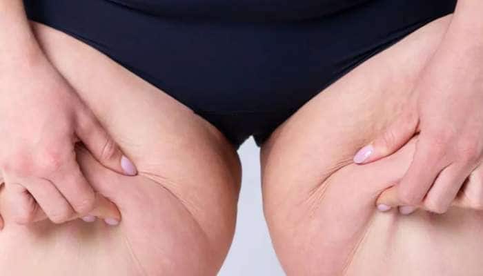 Lower Body Fat: કમર નીચેના અંગો પર વધતી ચરબી આ બીમારીનું લક્ષણ હોય શકે છે