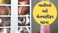 5 રૂપિયાની ચોકલેટ 35 હજારમાં પડી, વડોદરામાં 4 વર્ષની બાળકી LED બલ્બ તાર સાથે ગળી ગઇ