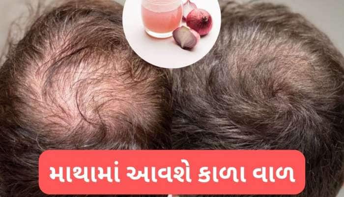ડુંગળીના રસ સાથે આ વસ્તુ ત્યાં લગાડો જ્યાંથી વાળ ખરી ગયા હોય, કાળા વાળ ઉગવા લાગશે