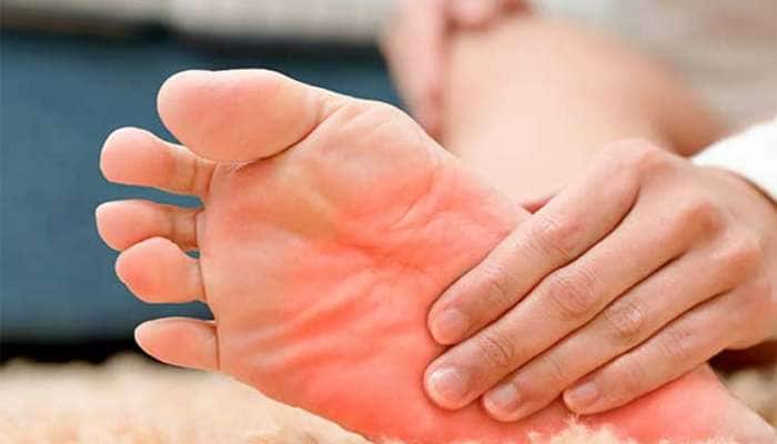 Burning Feet: પગના તળિયામાં થતી બળતરાના કારણો અને બળતરા શાંત કરવાના ઉપાયો