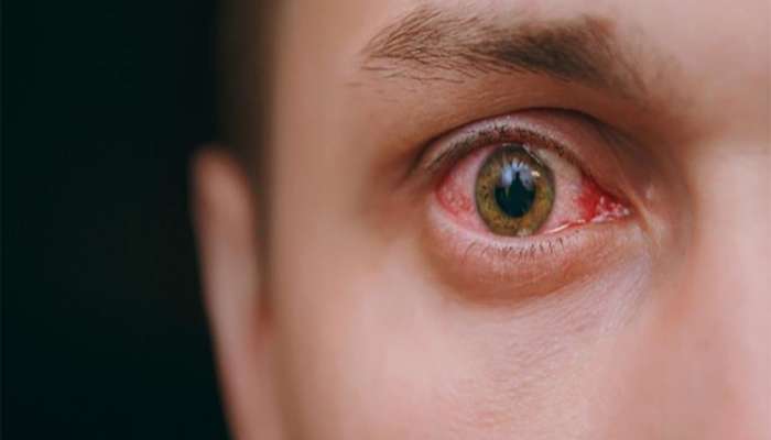 Red Eyes: સવારે જાગો ત્યારે આંખ લાલ હોવી આ બીમારીનું શરુઆતી લક્ષણ, ઈગ્નોર કરવાની ભુલ ન કરવી