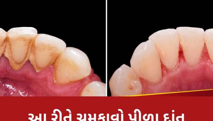 ગુટકા-પાન ખાઈને ગંદા પીળા થઈ ગયા છે દાંત? ચમકાવવા માટે અજમાવો આ ઘરગથ્થું ઉપાય