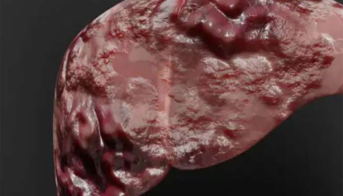 Fatty Liver: આંખોમાં થતી આ સમસ્યાઓ હોય શકે છે ફેટી લિવરનું લક્ષણ, સમયસર ધ્યાન આપો તો લિવર ડેમેજ ન થાય