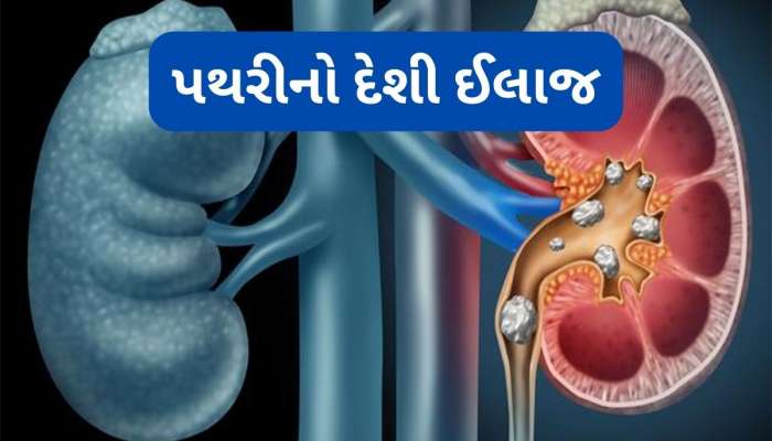 Kidney Stone: પથરી કાઢવાનો વર્ષો જુનો આયુર્વેદિક નુસખો, રોજ સવારે પી લેવું આ ખાસ ડ્રિંક