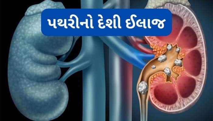 Kidney Stone: પથરી કાઢવાનો વર્ષો જુનો આયુર્વેદિક નુસખો, રોજ પી લો આ ખાસ ડ્રિંક