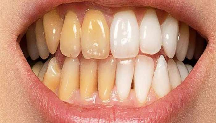 Yellow Teeth: પીળા દાંતને સફેદ કરવાનો અચૂક ઉપાય, આ 2 વસ્તુથી કરો દાંતની સફાઈ, તુરંત દેખાશે અસર
