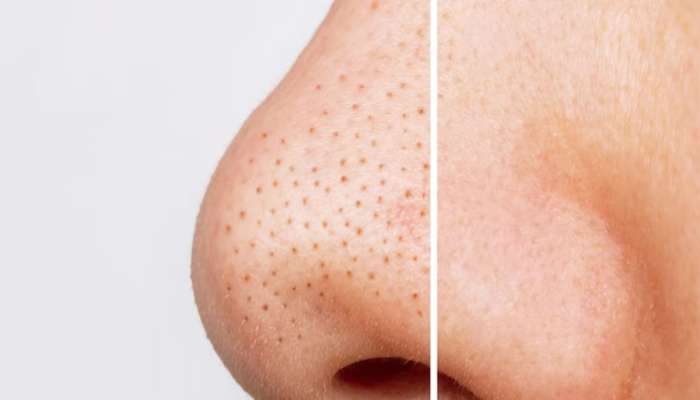 Blackheads: નાક આસપાસના બ્લેકહેડ્સ દુર કરવાની સૌથી સરળ રીત, 5 મિનિટમાં સ્કિન થઈ જાશે ક્લીન