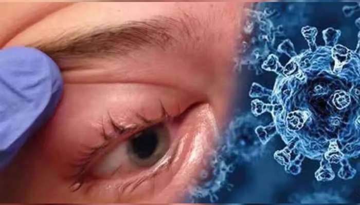 કોરોનાની નવી લહેર વચ્ચે ગુજરાત પર આવ્યું સંકટ, આવ્યા આ બીમારીના દર્દી, એકની આંખ કાઢવી પડી  