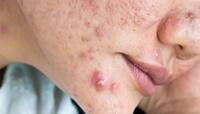 Pimples: એકવાર ખીલ મટશે પછી પાછા નહીં થાય ક્યારેય, અજમાવી જુઓ આ 10 ટીપ્સ