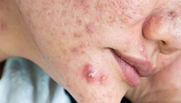 Pimples: એકવાર ખીલ મટશે પછી પાછા નહીં થાય ક્યારેય, અજમાવી જુઓ આ 10 ટીપ્સ