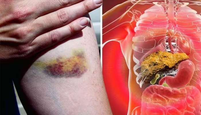 Liver Health: ઉનાળામાં ફક્ત ગરમીના કારણે જ નહીં લિવરના રોગના કારણે પણ ભૂખ નથી લાગતી
