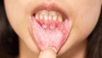 Mouth Ulcers: આ છે અજમાવેલા નુસખા, મોઢાના ચાંદા મિનિટોમાં મટી જશે, તુરંત થશે આરામ