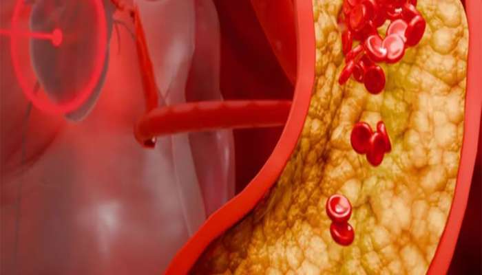 Bad Cholesterol: નિયમિત ખાવા લાગો આ 4 ફણગાવેલા અનાજ, નસોમાં વર્ષોથી જામેલું બેડ કોલેસ્ટ્રોલ પણ થઈ જશે સાફ