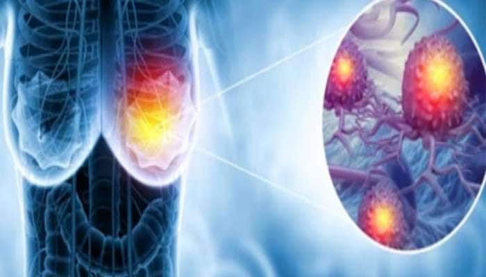 બ્રેસ્ટ કેન્સરનું જોખમ ઘટાડે છે આ 5 ફૂડ, એક્સપર્ટ કહે છે મહિલાઓએ રોજ ખાવા જોઈએ