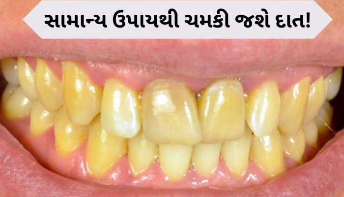  દૂધની જેમ સફેદ થઈ જશે પીળા દાત, બસ આ એક વસ્તુનો કરો ઉપયોગ