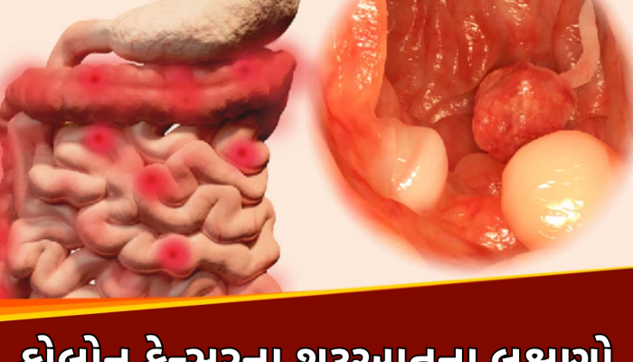 Colon Cancer Symptoms: કોઈ કારણ વગર ઝડપી ઘટી રહ્યું છે વજન તો થઈ જાવ સાવધાન, કોલોન કેન્સરનો હોય શકે છે સંકેત