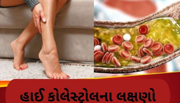  Cholesterol: કોલેસ્ટ્રોલ વધે તો શરીરના આ 3 ભાગમાં થાય છે જોરદાર દુખાવો, તત્કાલ રિપોર્ટ કરાવો