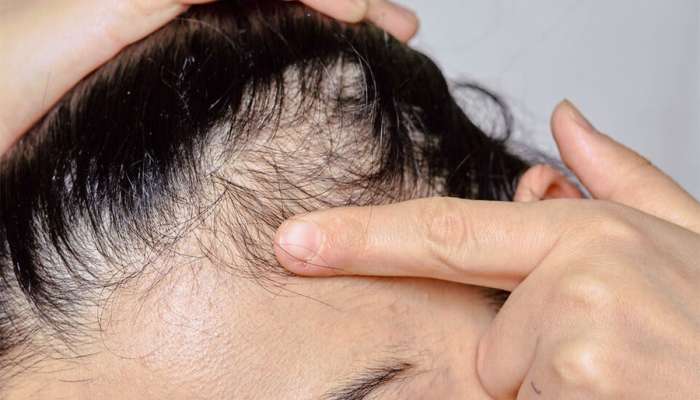 Hair Growth: થોડા દિવસ માટે વાળમાં રોજ લગાડો આ વસ્તુ, માથામાંથી ખરી ગયેલા વાળ 100 ની સ્પીડે પાછા ઉગવા લાગશે