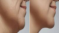 Face Yoga: રોજ સવારે કરી લો આ 5 યોગાસન, ચહેરાની ઢીલી પડેલી સ્કિન પણ ટાઈટ થવા લાગશે
