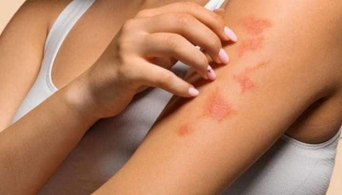 Monsoon Skin Care: ચોમાસામાં થતી ત્વચાની સમસ્યાથી બચવાના સરળ ઉપાય
