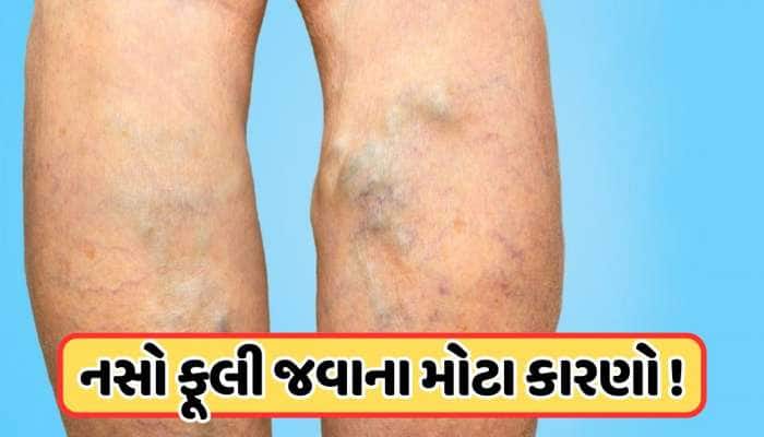 આ 4 કારણે પગમાં જોવા મળે છે વાદળી-લીલી નસો, જાણો તેનાથી કેવી રીતે બચવું !