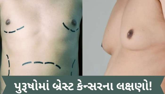 પુરૂષોને પણ થઈ શકે છે બ્રેસ્ટ કેન્સર? આ 4 લક્ષણોને નજરઅંદાજ કરવાથી જઈ શકે છે જીવ!