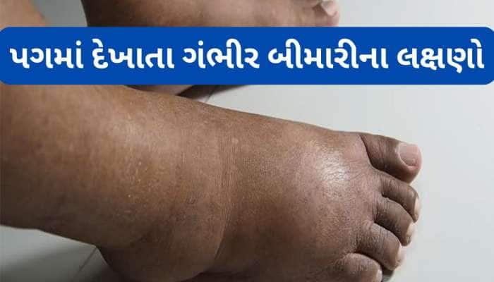 પગમાં સોજા સહિત આ 5 ફેરફાર દેખાય તો ડોક્ટર પાસે જવું, ગંભીર બીમારીનું લક્ષણ હોય શકે
