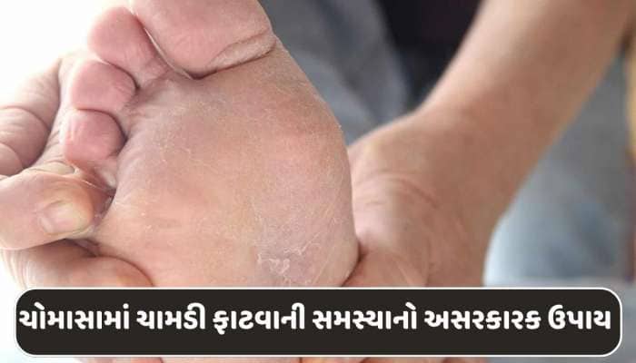 ચોમાસામાં કેમ પગની ચામડી ફાટી જાય છે? આ રહ્યો તેનો ઈલાજ...
