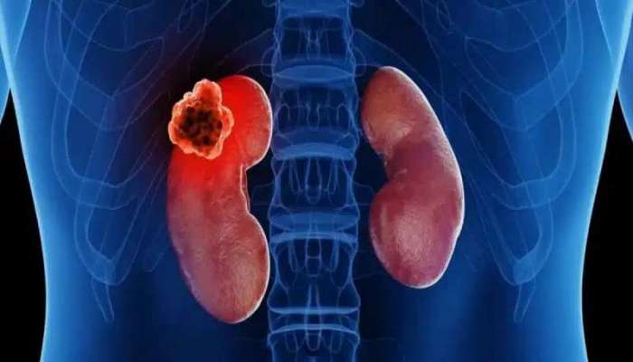 કઈ પાંચ ભૂલને કારણે ડેમેજ થઈ શકે છે કિડની? થઈ જાવ એલર્ટ, બાકી જકડી લેશે કેન્સર