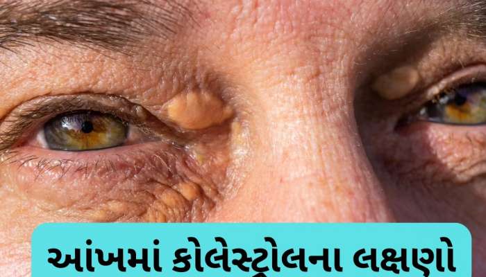 કોલેસ્ટ્રોલ વધવાથી આંખમાં જોવા મળે છે આ 4 લક્ષણ, ગમે ત્યારે બંધ થઈ જશે નસો, નજરઅંદાજ ન કરતા