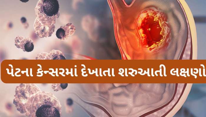 Stomach Cancer: સવારે ઉઠતા વેંત થતી આ 5 સમસ્યા હોય શકે છે પેટમાં કેન્સરની શરુઆત, તુરંત કરવો ડોક્ટરનો સંપર્ક