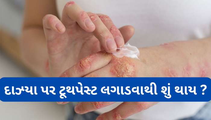 Burn Injuries: દાઝ્યા પર ટુથપેસ્ટ લગાડવી કે નહીં ? જાણો બળેલી ત્વચા પર સૌથી પહેલા શું લગાડવું ?