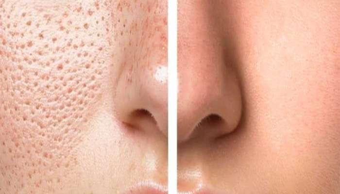Open Pores: મુલતાની માટીમાં આ 3 વસ્તુઓ મિક્સ કરી લગાડો સ્કિન પર, ઓપન પોર્સ નેચરલી ઓછા થવા લાગશે
