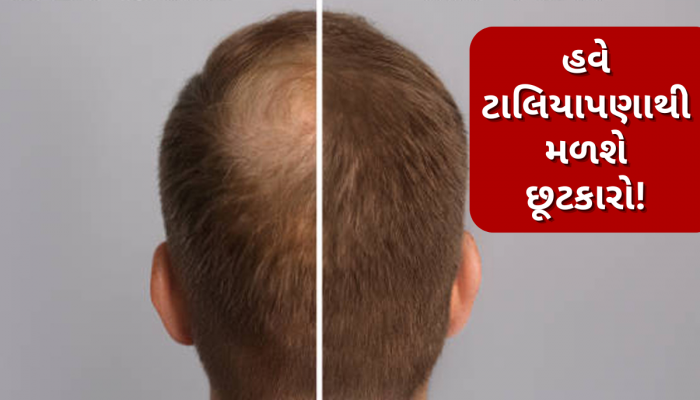 Baldness Treatment: ટાલ પડવી પરમેનેન્ટ નથી, વૈજ્ઞાનિકનો દાવો- હવે સર્જરી અને દવા વગર પોસિબલ છે હેર રિગ્રોથ