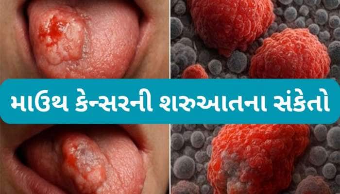 મોઢામાં કેન્સર થયું હોય તો શરુઆતમાં દેખાય આ 8 સંકેત, સામાન્ય ગણી ઈગ્નોર ન કરવા