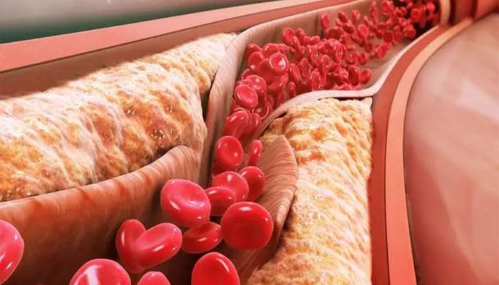 Bad Cholesterol: બેડ કોલેસ્ટ્રોલ વધે ત્યારે આ અંગમાં રહે દુખાવો, જાણો બેડ કોલેસ્ટ્રોલનો આયુર્વેદિક ઈલાજ
