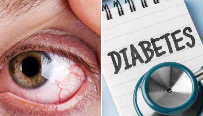 Diabetes: આંખમાં જોવા મળે છે ડાયાબિટીસનું પ્રથમ લક્ષણ, જાણો ક્યારે સાવચેતી રાખવી જરૂરી