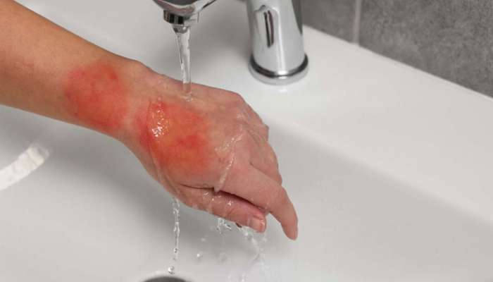Burn Injury: ગરમ તેલ, વરાળ કે ગેસની આંચ.. કોઈપણ વસ્તુથી દાઝ લાગે તો સૌથી પહેલા આ કામ કરજો, ચામડી પર ફોડલા નહીં પડે