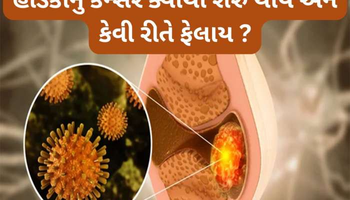 Bone Cancer: શરીરમાં ક્યાંથી શરુ થાય હાડકાનું કેન્સર ? જાણો હાડકાના કેન્સરથી બચવા શું કરવું જોઈએ
