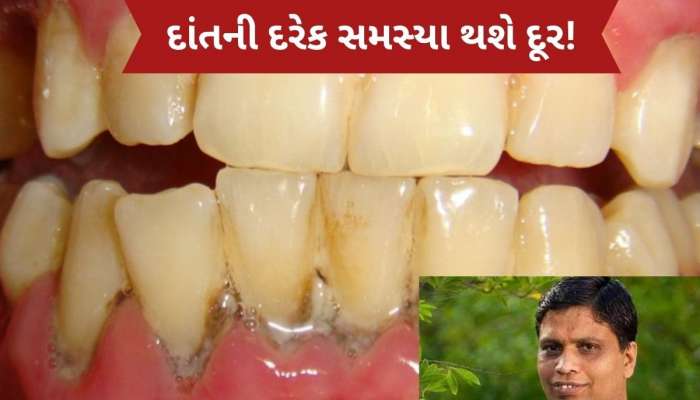  એક-એક દાંત મજબૂત બનશે, મોતી જેવી ચમક આવી જશે, આચાર્ય બાલકૃષ્ણએ જણાવ્યો દેશી ઉપાય
