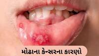આ છે મોઢાના કેન્સરના વિચિત્ર કારણ! વ્યસન ન હોય તે લોકો પણ આવે છે ઝપેટમાં