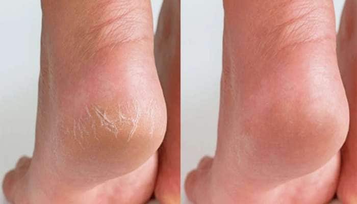 ડ્રાય અને ફાટેલી એડી 7 દિવસમાં થઈ જશે ઠીક, રોજ રાત્રે ઘરે બનાવેલું આ તેલ લગાડવું