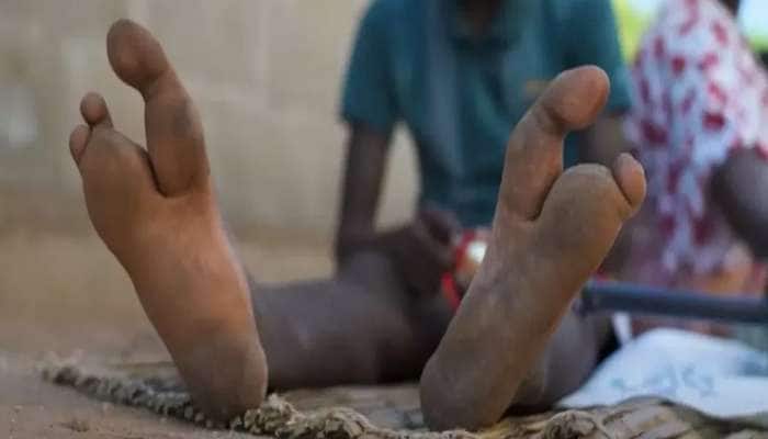 આ જનજાતિના પગમાં હોય છે માત્ર બે અંગૂઠા, એકપણ આંગળી નહીં! ખતરનાક છે જૂનો ઈતિહાસ