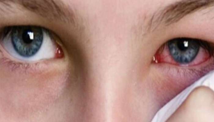 Eye Flu Remedies | How to treat eye flu at home | આંખ લાલ થવી