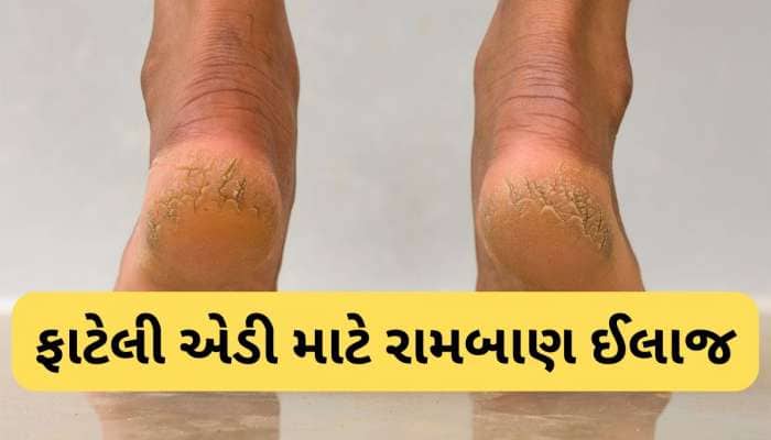 ફાટેલી એડી માટે રામબાણ છે આ 5 ઘરેલુ નુસખા, કોઈપણ 1 કરશો તો પણ તુરંત આરામ મળશે