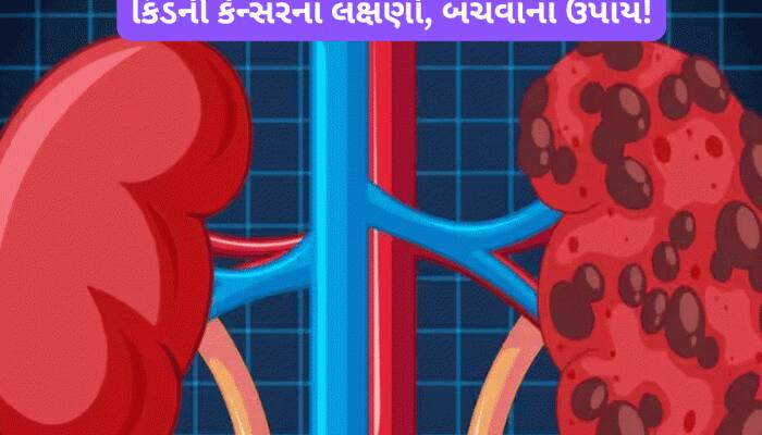 કિડની કેન્સર થતા પહેલા જોવા મળે છે આ 3 લક્ષણ, જાણો કેવી રીતે બચી શકો