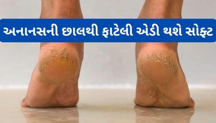 પગના વાઢિયા મટાડવા અનાનસની છાલનો આ રીતે કરો ઉપયોગ, રુ જેવી સોફ્ટ થઈ જશે ફાટેલી ત્વચા