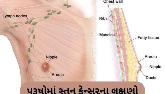 માત્ર મહિલાઓ જ નહીં, પુરૂષોને પણ થઈ શકે છે બ્રેસ્ટ કેન્સર! આ છે તેના શરૂઆતી લક્ષણ